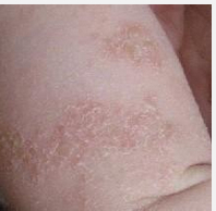 冬季干性湿疹图图片