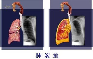 肺炭疽病的症状图片图片
