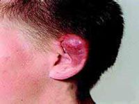 化脓性耳廓软骨膜炎