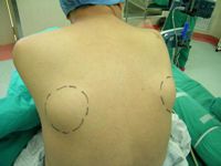 肩胛骨弹力纤维瘤图片图片