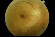 什么是黄斑病变 2014082911280436431.jpg