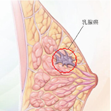 职业女性为什么易患乳腺癌?
