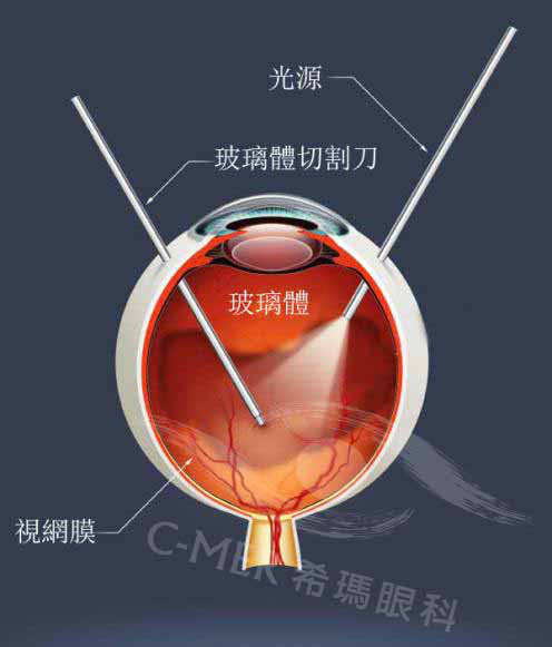 微创玻璃体切除术，治疗视网膜脱落