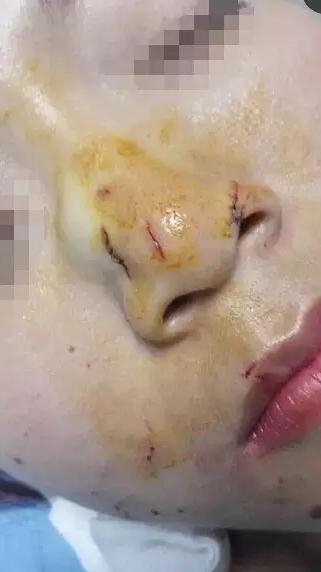 游客吻蛇被咬致毁容