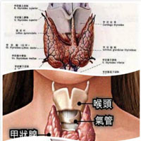 甲状腺结节钙化如何治疗