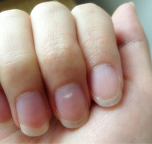 指甲上长白点代表肚子长虫吗？