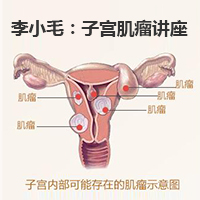 积极预防 科学治疗——警惕妇科‘第一瘤’