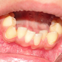 为什么现在患牙病的人特别多?