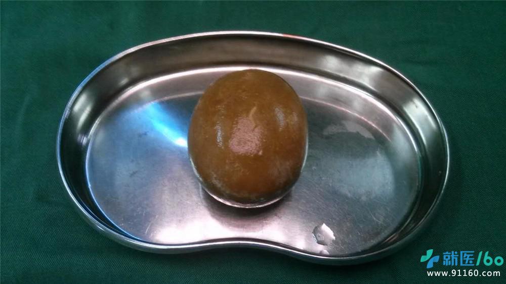 郑州一患者膀胱内取出直径9厘米结石,医生都被惊呆