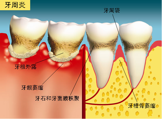 防治牙周病,远离老掉牙