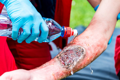 烫伤后涂牙膏,有用吗?