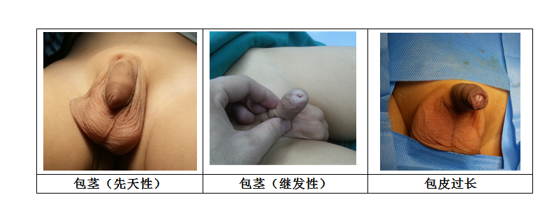 包皮过长和包茎.png