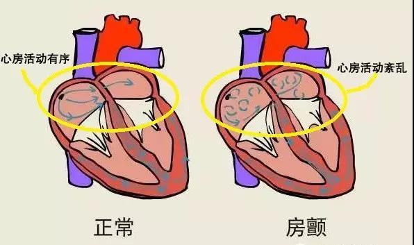 房颤图.jpg