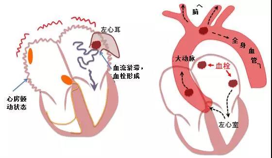 房颤危害.jpg