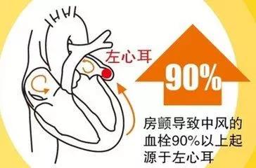 心耳血栓.jpg