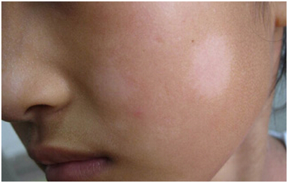 在出生时或生后不久发病,皮损为局限性淡白斑,境界模糊,周围无色素