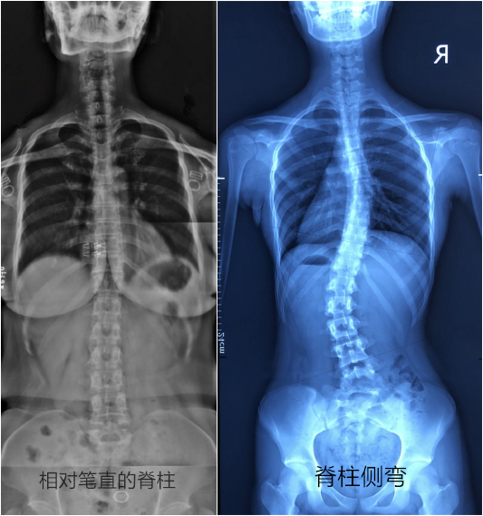笔直的脊柱_副本_副本.png