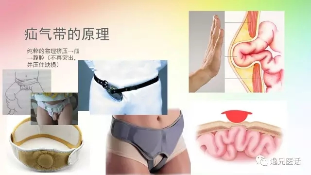 疝气带原理.webp.jpg