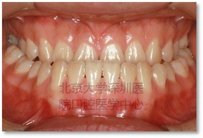 牙正面1.jpg