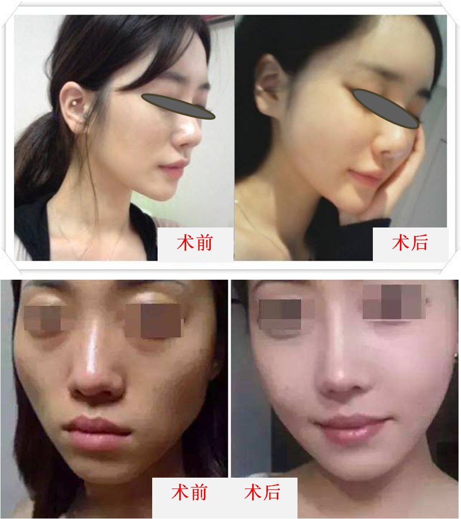手术前后.png