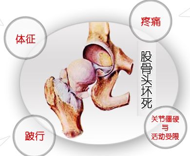 股骨头坏死.jpg