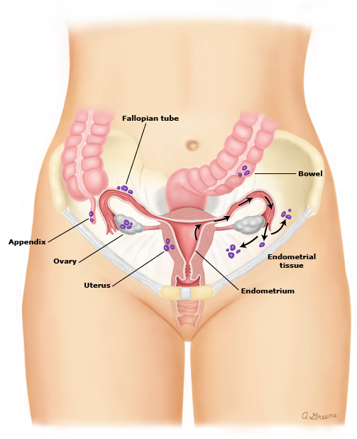 Endometriosis_pelvis_PI_edt.jpg