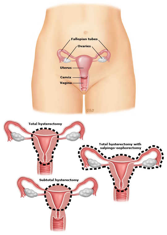 Abdom_hysterectomy_PI_edt.jpg