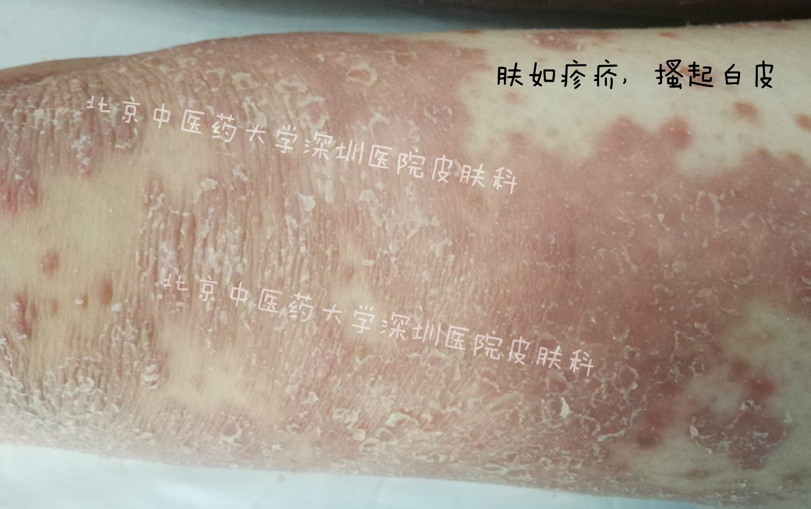 肤如疹疥meitu_2.jpg