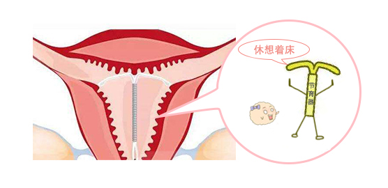 节育器4.jpg
