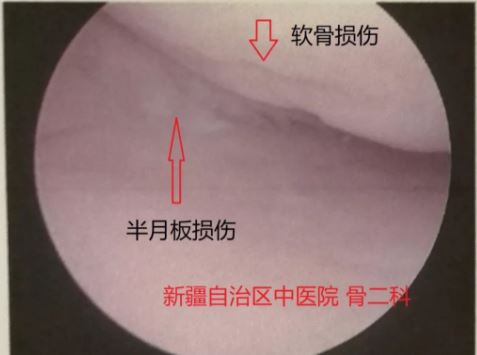 半月板损伤后软骨损伤.JPG