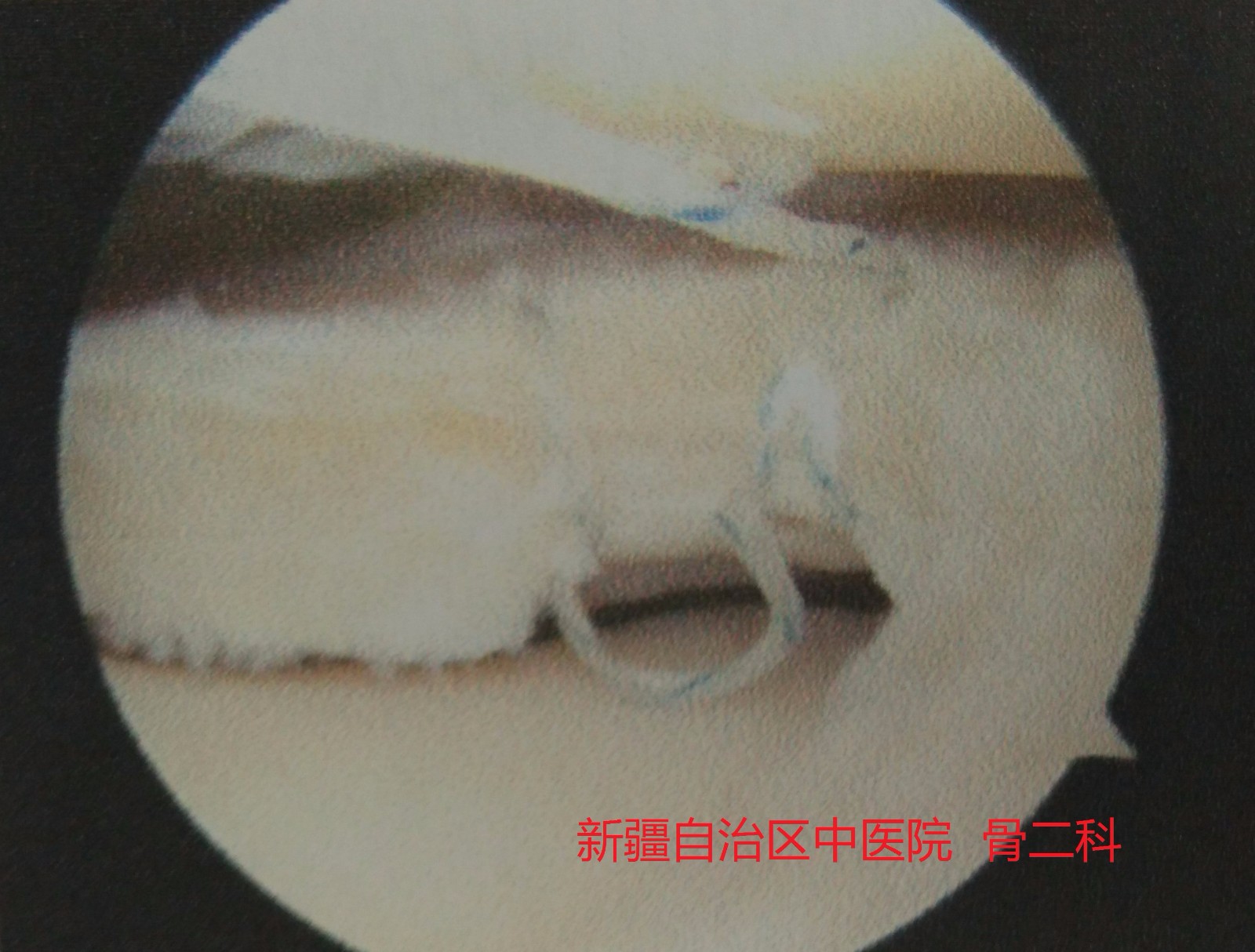 半月板修整 (4).jpg