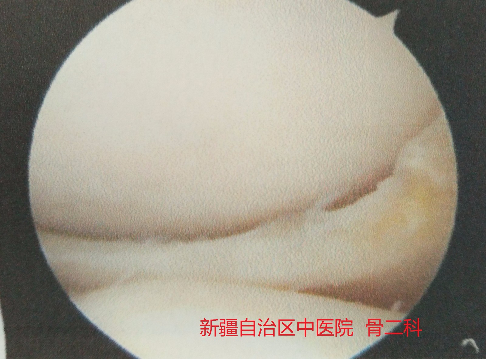 半月板修整 (3).jpg