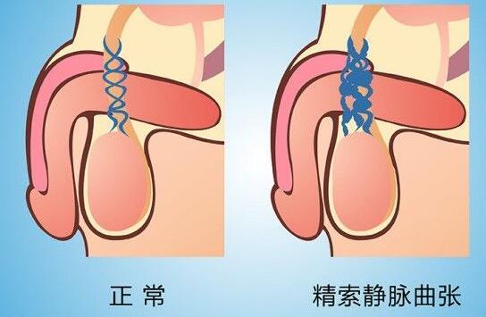 静脉曲张05.jpg