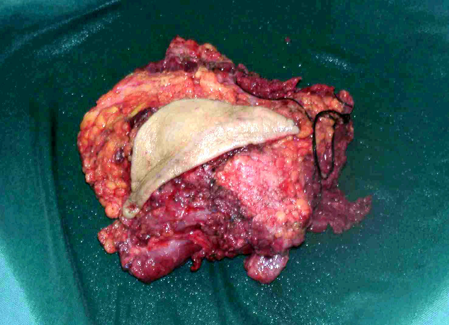 骨化性纤维瘤图片