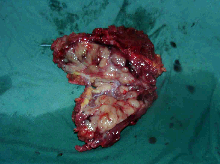 骨化性纤维瘤图片图片