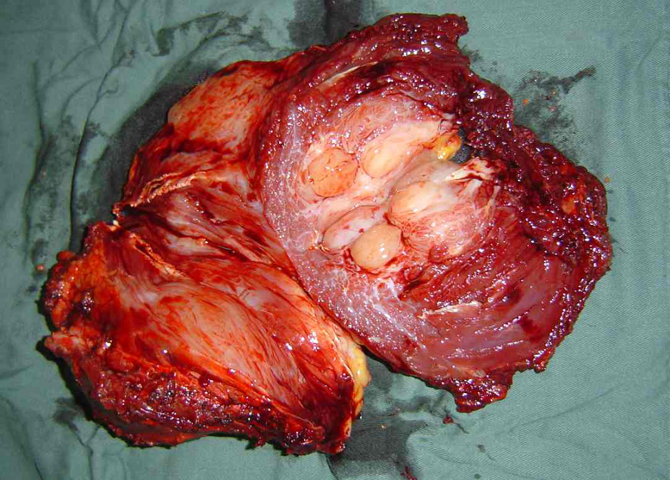 骨腫瘤醫學科普脂肪肉瘤liposarcoma