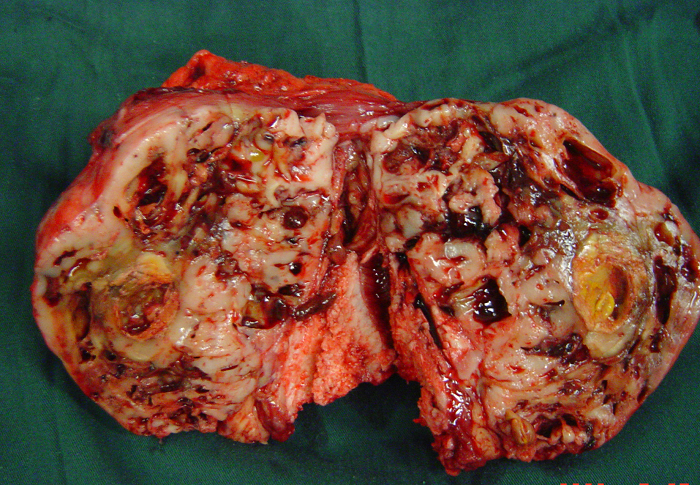 骨腫瘤醫學科普骨肉瘤osteosarcoma