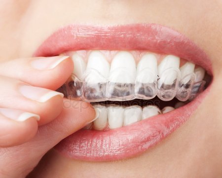 depositphotos_9941603-stock-photo-teeth-with-whitening-tray.jpg