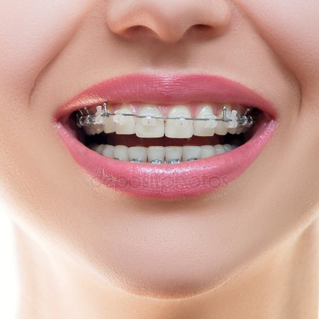 depositphotos_94878102-stock-photo-braces-on-teeth-front-view.jpg