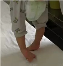 尖足1.webp.jpg