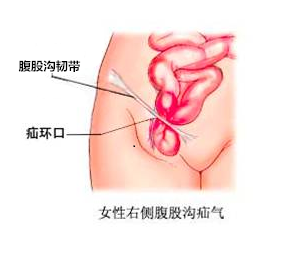 小儿疝女_副本.png
