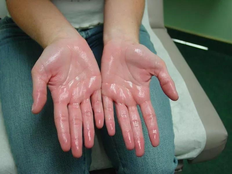 手汗症是因紧张,兴奋,压力或夏天高温时,交感神经机能亢进造成手掌