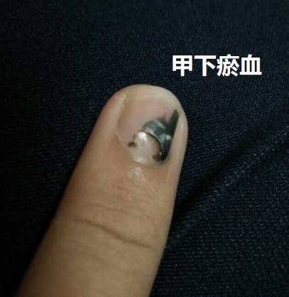甲下瘀血.jpg