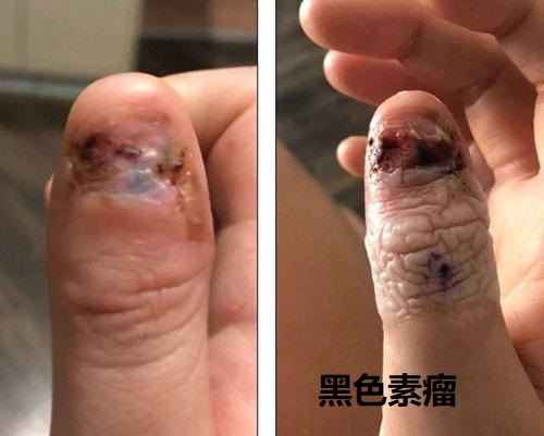 甲下黑色素瘤.jpg