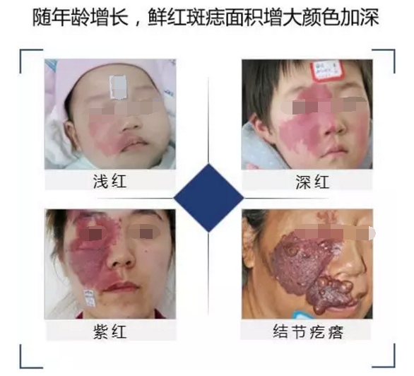 鲜红斑痣.png
