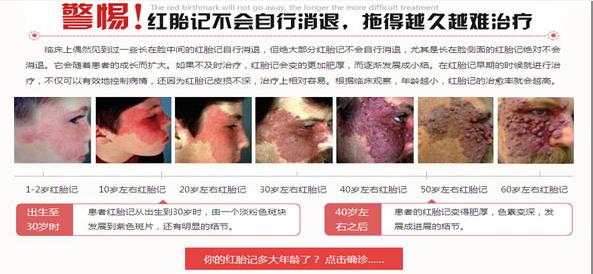 红胎记危害.jpg