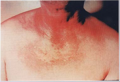 红色斑丘疹艾滋病图片