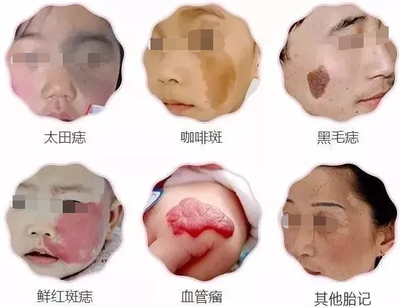 胎记总.png