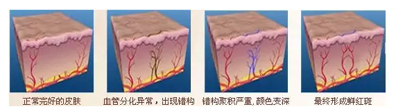 鲜红斑痣1.png