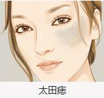 太田痣 (4).png